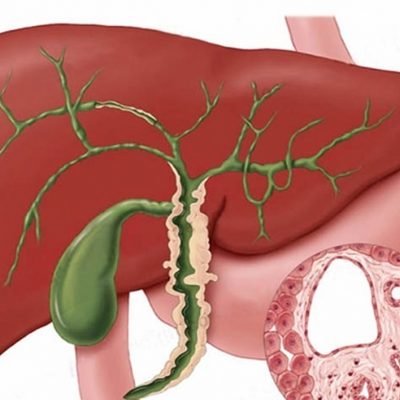 primary_sclerosing_cholangitis